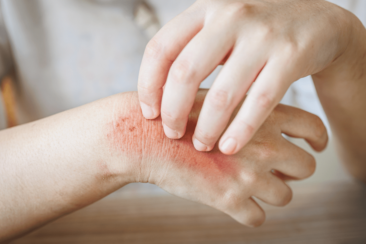 Person scratching irritated, inflamed skin on their wrist.