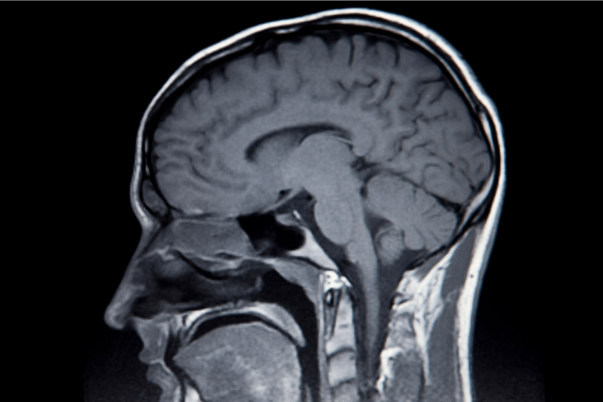 MRI scan showing a sagittal view of the human brain.